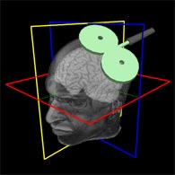 Neurologie TMS Navigation